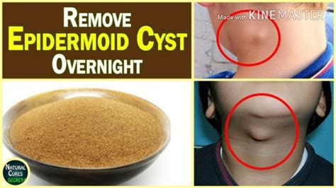 Amazinghome Remedy To Remove Cysts And Grease Bail Forever In Just 7