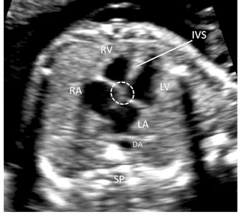 Transverse Axial Sonogram Of Thorax Showing 4 Chamber Fetal Heart At 20