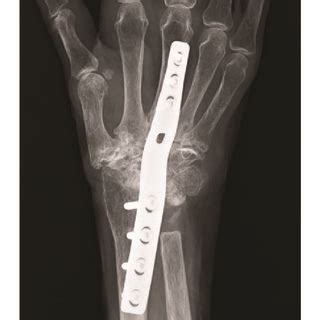 Photographs Showing The Ao Wrist Fusion Plate With A Short Bend And The Download Scientific