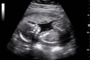 How To Read An Ultrasound Gender And And Abnormality New Health Advisor