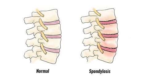 Spondylosis Symptoms Causes Treatment And Rehabilitation