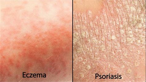 Udin 33 Early Stage Eczema Psoriasis