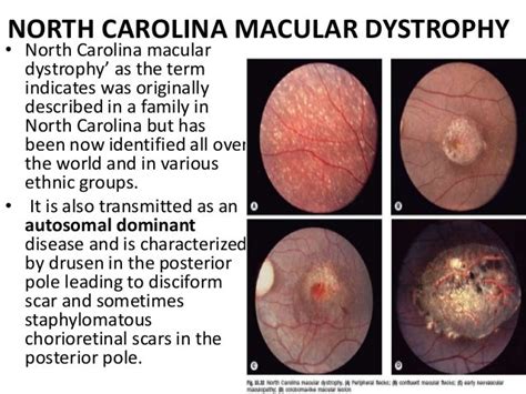Macular Dystrophies