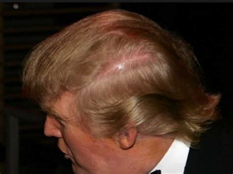 Not everyone in your life will be paying as close attention as 90% of the transplanted hair remains permanent. Finally, The Reason Melania Trump Squints! - Popdust