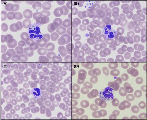 The Rare Green‐blue Neutrophil Inclusion Bodies Worth Reporting In