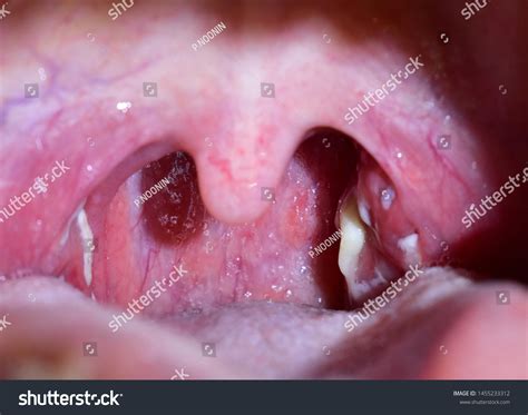 12071 Tonsillitis Images Stock Photos And Vectors Shutterstock