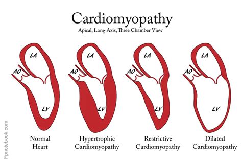 Cardiomyopathy Types Symptoms Diagnosis And Treatment