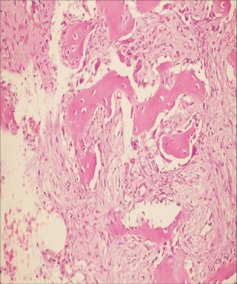 İnstagram ve scorp gibi sosyal medya. A. Stromal fibroblasts producing bony matrix without ...