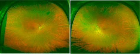 Optos Photos Showing A Normal Right Fundus And B Left Optic Nerve