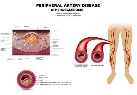 Peripheral Artery Disease A Common And Costly Vascular Issue