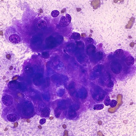 Hepatocellular Carcinoma Fna Cytology Microscopic Cells Med Tech