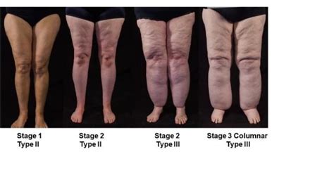 Lipedema Treatment Stages Causes Types Diet Plan By Fitelo