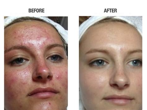 The Pros And Cons Of Acne Laser Treatments Medi Port Services