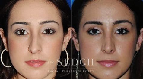 Deviated Septum Before And After