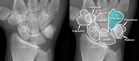 Trauma X Ray Upper Limb Gallery 2 Wrist Hamate Fracture