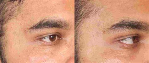 Milia Before After Results Clear Skin Pune