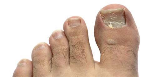 Though effective, some people experience unpleasant side effects. Toenail fungus has many remedies, but is hard to cure