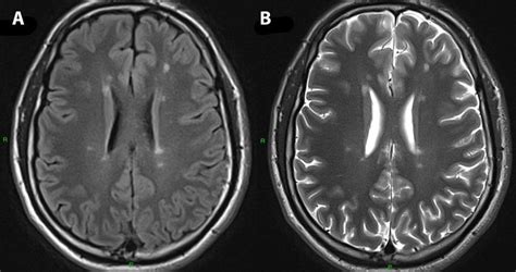 Axial Flair Left And T2 Right Brain Mri Show Multiple Lesions
