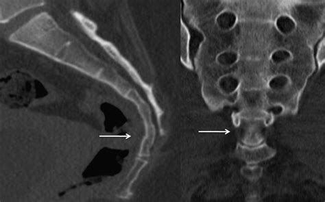 Isolated Transverse Sacral Fractures The Spine Journal