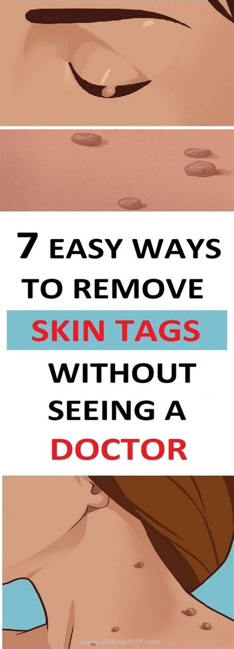 7 easy ways to remove skin tags without seeing a doctor in 2020 skin tag removal skin tag