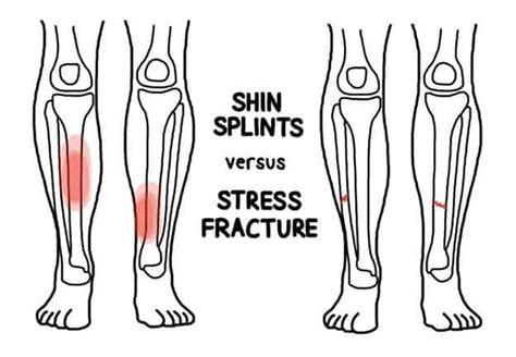 Stress Fracture Vs Fracture