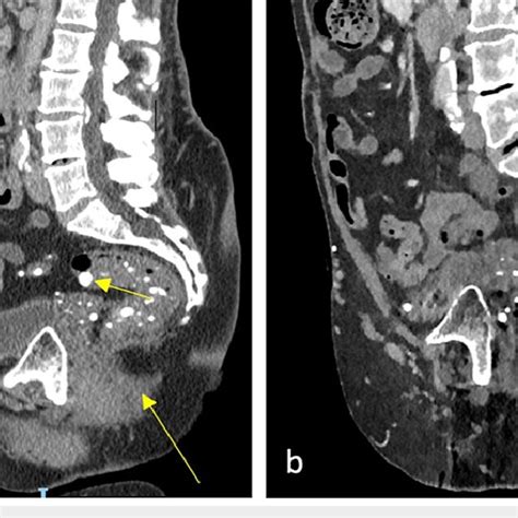 Sagittal Sections Of Pelvic Ct Before A And After B Hartmanns