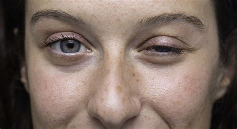 Close Up On Blue Eyes Girl Face With One Half Closed Eye Myasthenia