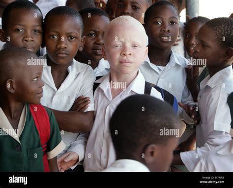 Albino People Hunted In Africa