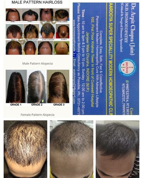 Hair Baldness Alopecia Cured By Modern Homoeopathy Treatment In Natural