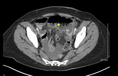 Cureus Acute Appendicitis And Small Bowel Obstruction Secondary To