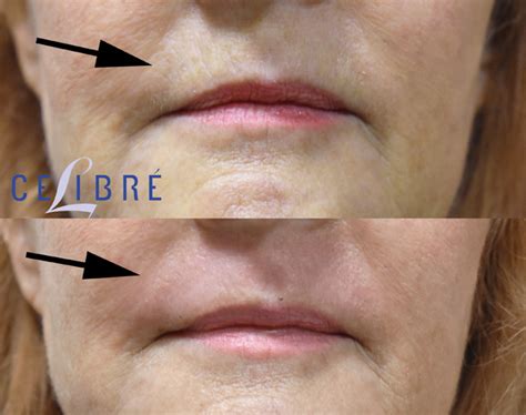 Dermal Fillers For Lip Lines Before And After