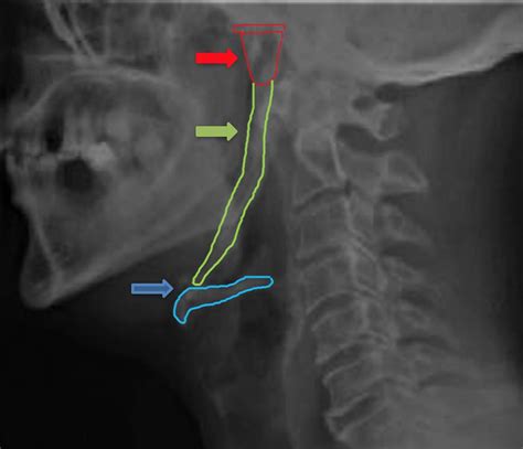 Incidental Finding Of A Bilateral Complete Ossification Of Stylohyoid