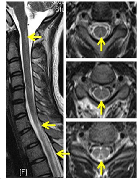 The Mri Of Spinal Cord Disclosed Abnormal Hyperintensities Within The