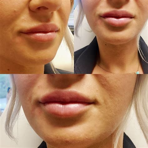 Syringe Juvederm Ultra Plus Xc To Patient S Lips Who Was Desiring
