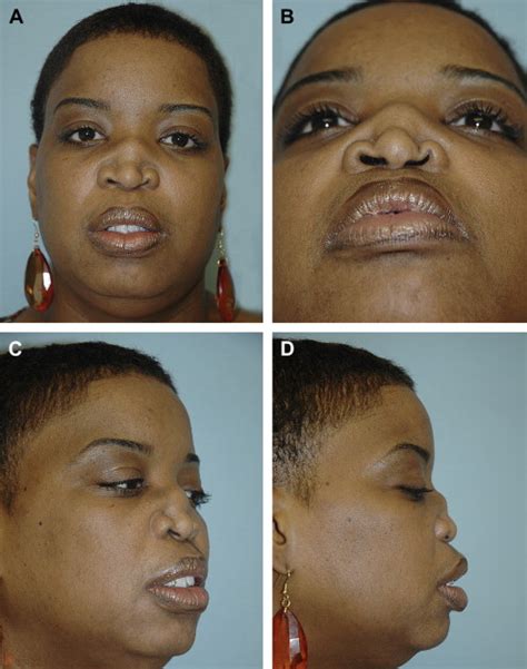 Complications And Management Of Septoplasty Ento Key