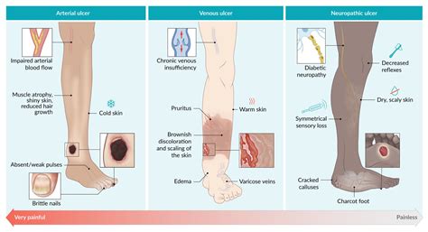 Venous Ulcer Vs Arterial Ulcer