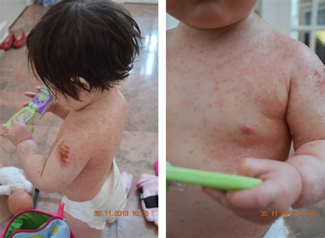 Traditional Chinese Medicine Helped My Daughters Eczema