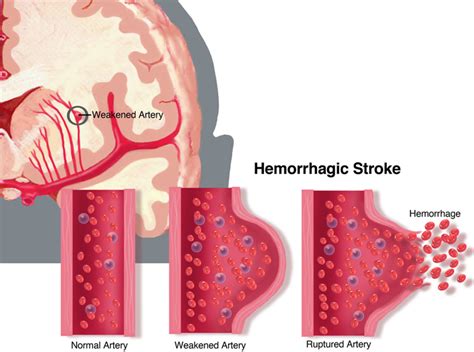 Hemorrhagic Stroke Pathophysiology