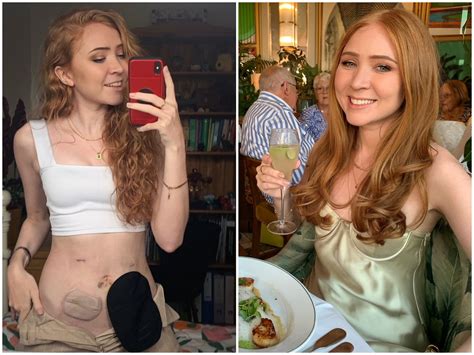 Woman Who Got A Stoma Bag At 25 Says It Has Given Her Back Her Life The Independent