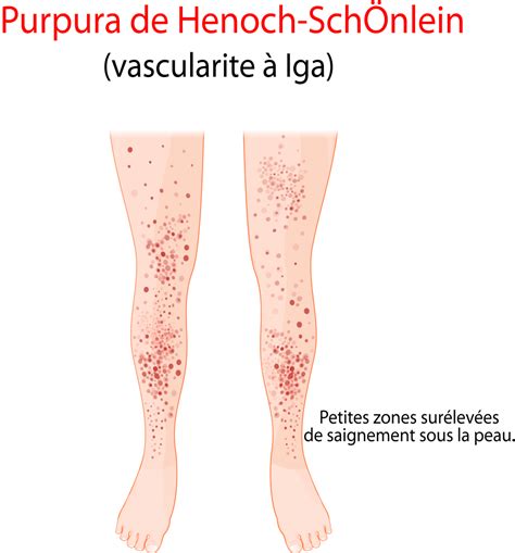 Purpura causes symptômes et traitements
