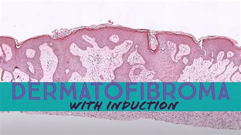 Dermatofibroma With Induction Phenomenon Pathology Dermpath