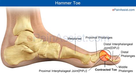 Hammer Toe Or Contracted Toecausestreatment How Does Hammer Toe