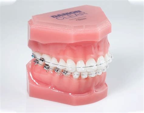 Adult Braces Bovenizer Baker Orthodontics