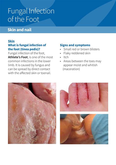 Fungal Infection Of The Foot By Yishun Health Issuu