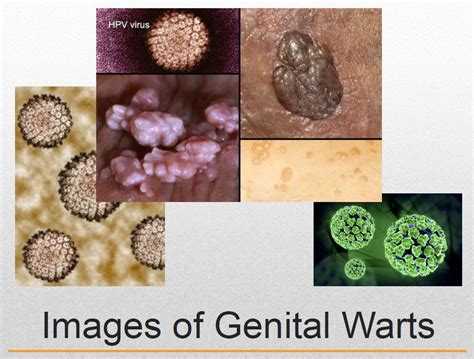 Warts Genital Images