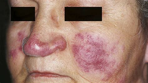 Malar Rash Causes Symptoms Treatment Picture And More