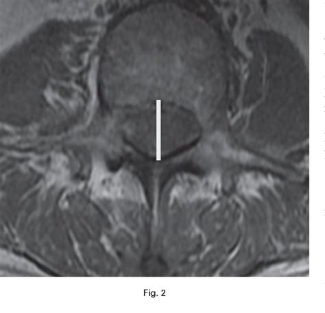 figure 2 from the influence of developmental spinal stenosis on the risk of re‐operation on an