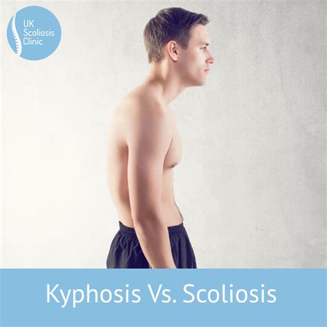 Kyphosis Vs Hyperkyphosis Scoliosis Clinic Uk Treating Scoliosis