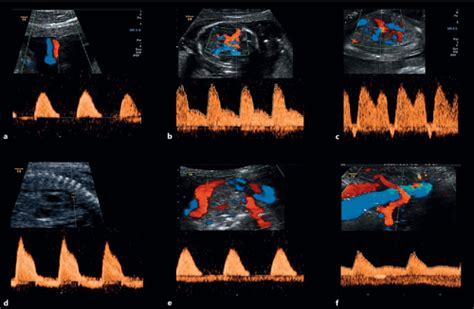 Prenatal Diagnosis Of A Placental Infarction Hematoma Associated With