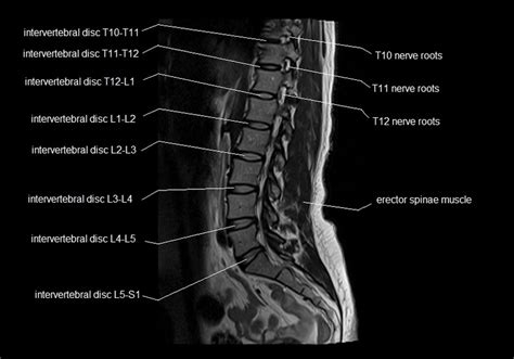Mri Spine Anatomy Free Mri Lumbar Spine Sagittal Cross Sectional Anatomy
